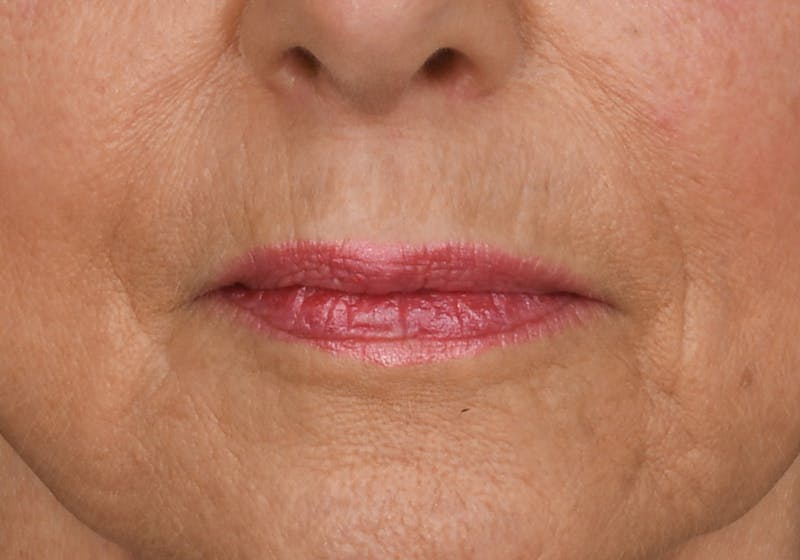 Lip Lift Before & After Gallery - Patient 194530 - Image 1
