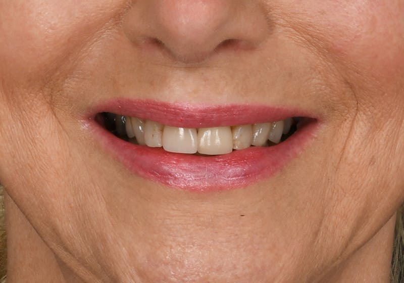 Lip Lift Before & After Gallery - Patient 194530 - Image 3