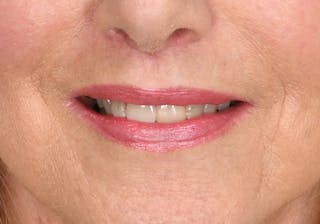 Lip Lift Before & After Gallery - Patient 194530 - Image 4