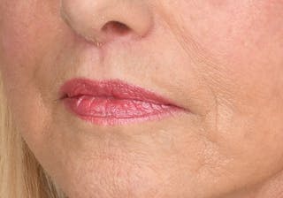 Lip Lift Before & After Gallery - Patient 194530 - Image 6