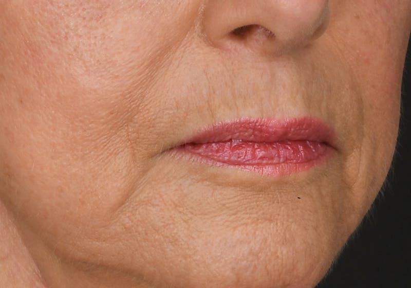 Lip Lift Before & After Gallery - Patient 194530 - Image 7