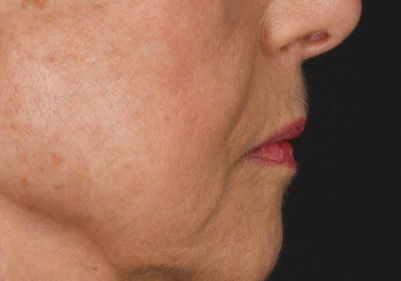 Lip Lift Before & After Gallery - Patient 194530 - Image 11