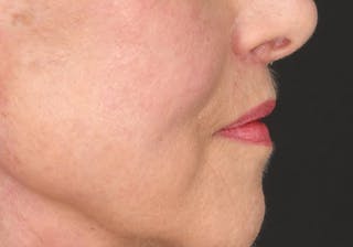 Lip Lift Before & After Gallery - Patient 194530 - Image 12