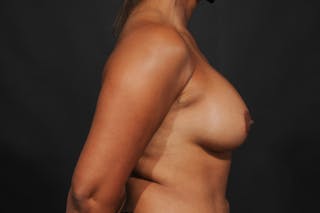 Breast Augmentation Before & After Gallery - Patient 140122614 - Image 12