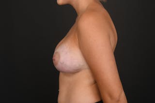 Breast Augmentation Before & After Gallery - Patient 131146 - Image 12