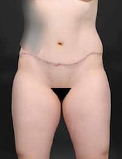Tummy Tuck Before & After Gallery - Patient 133214403 - Image 2