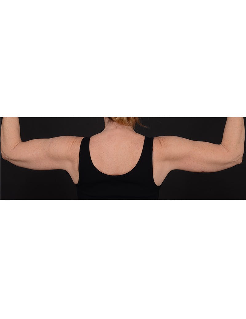 Arm Lift Before & After Gallery - Patient 120040 - Image 4