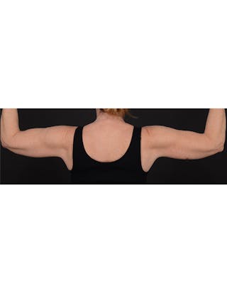 Arm Lift Before & After Gallery - Patient 120040 - Image 4