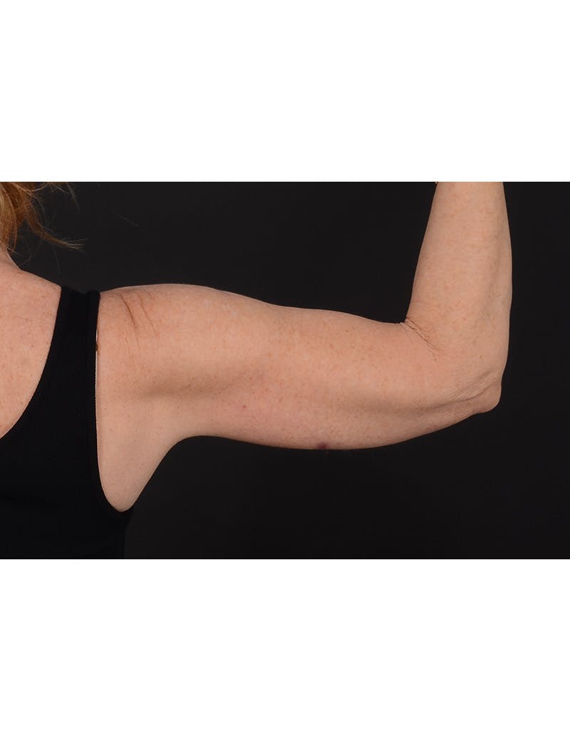 Arm Lift Before & After Gallery - Patient 120040 - Image 6