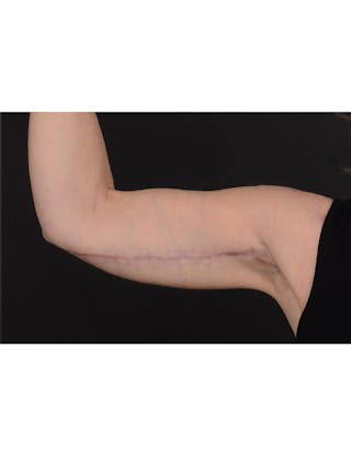 Arm Lift Before & After Gallery - Patient 120040 - Image 2