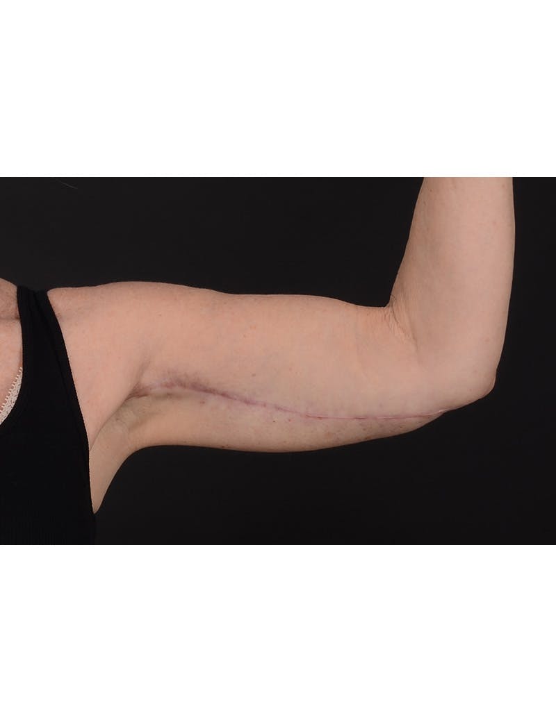 Arm Lift Before & After Gallery - Patient 120040 - Image 8