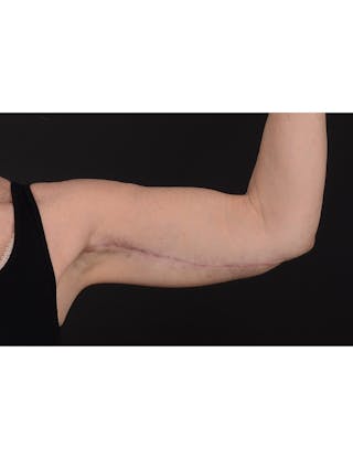Arm Lift Before & After Gallery - Patient 120040 - Image 8