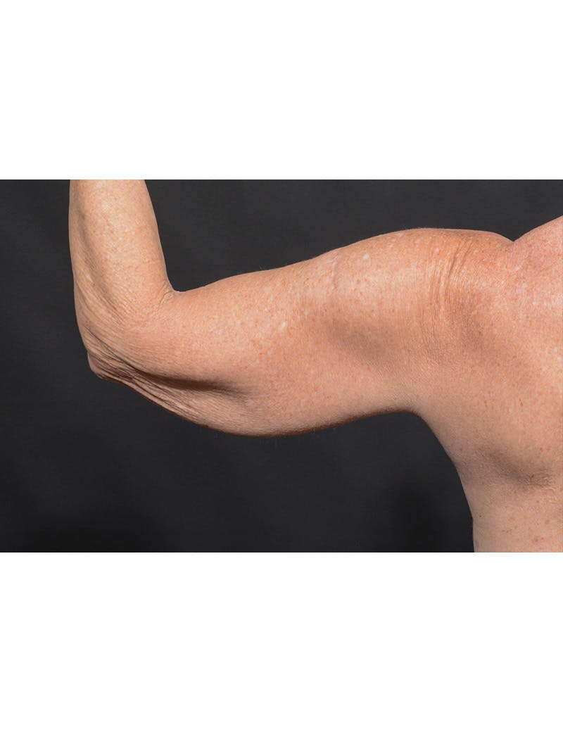 Arm Lift Before & After Gallery - Patient 120040 - Image 9