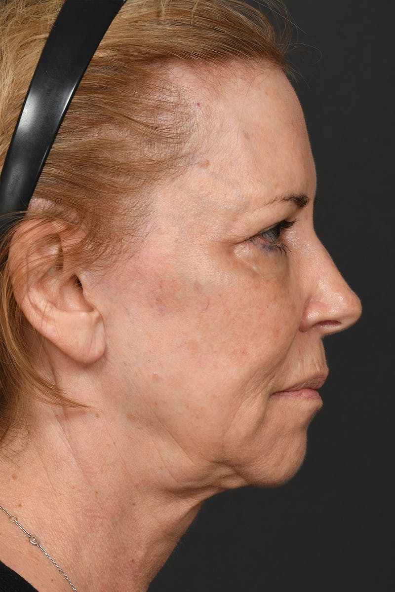 Facelift Before & After Gallery - Patient 191789 - Image 7