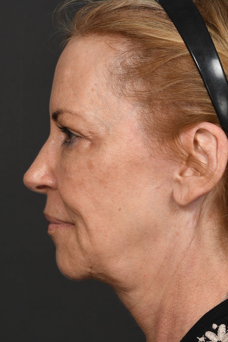 Facelift Before & After Gallery - Patient 191789 - Image 11