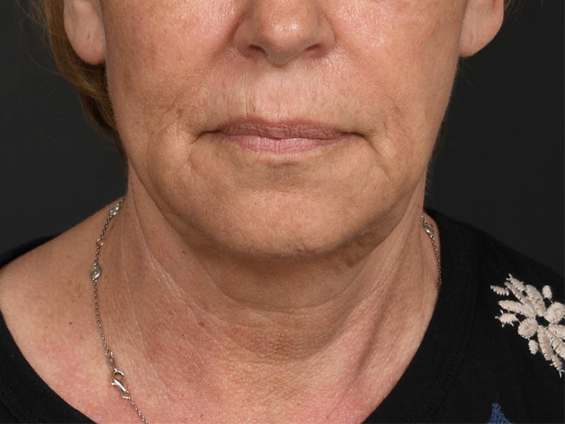 Neck Lift Before & After Gallery - Patient 801111 - Image 3