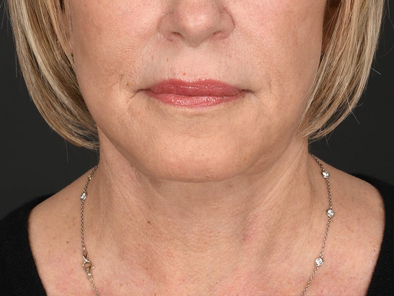 Neck Lift Before & After Gallery - Patient 801111 - Image 4