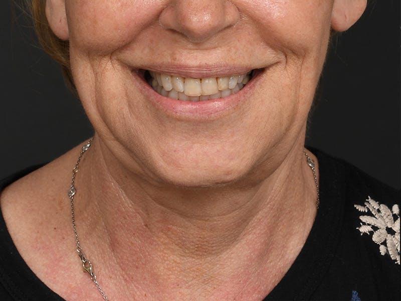 Neck Lift Before & After Gallery - Patient 801111 - Image 5