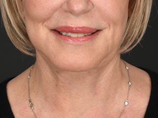 Neck Lift Before & After Gallery - Patient 801111 - Image 6