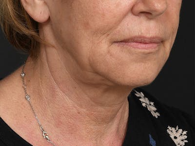 Neck Lift Before & After Gallery - Patient 801111 - Image 1