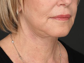 Neck Lift Before & After Gallery - Patient 801111 - Image 2