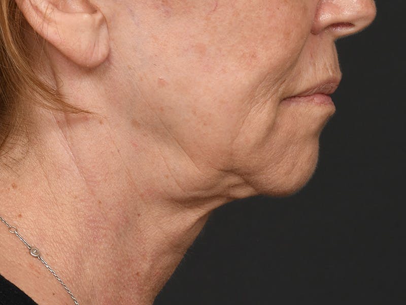 Neck Lift Before & After Gallery - Patient 801111 - Image 7