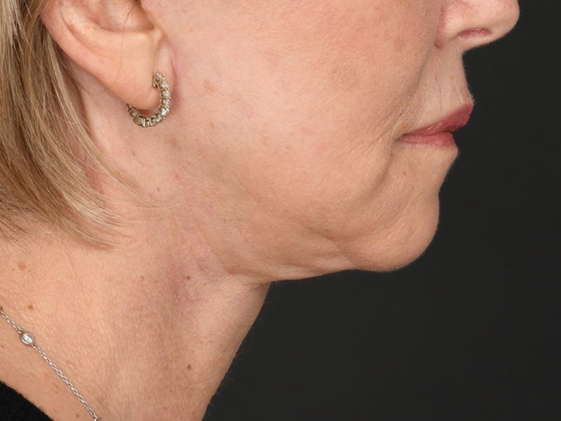 Neck Lift Before & After Gallery - Patient 801111 - Image 8