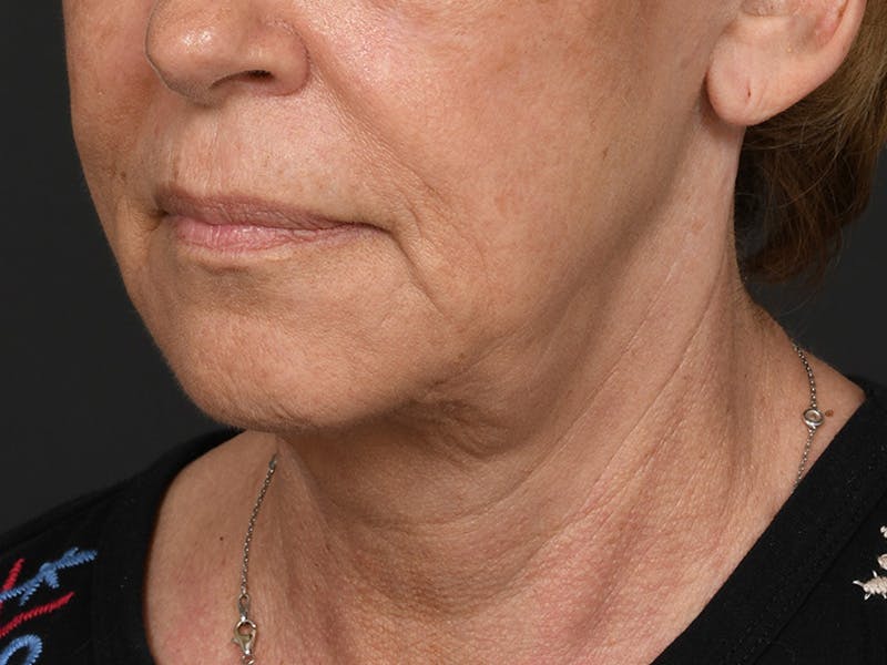 Neck Lift Before & After Gallery - Patient 801111 - Image 9