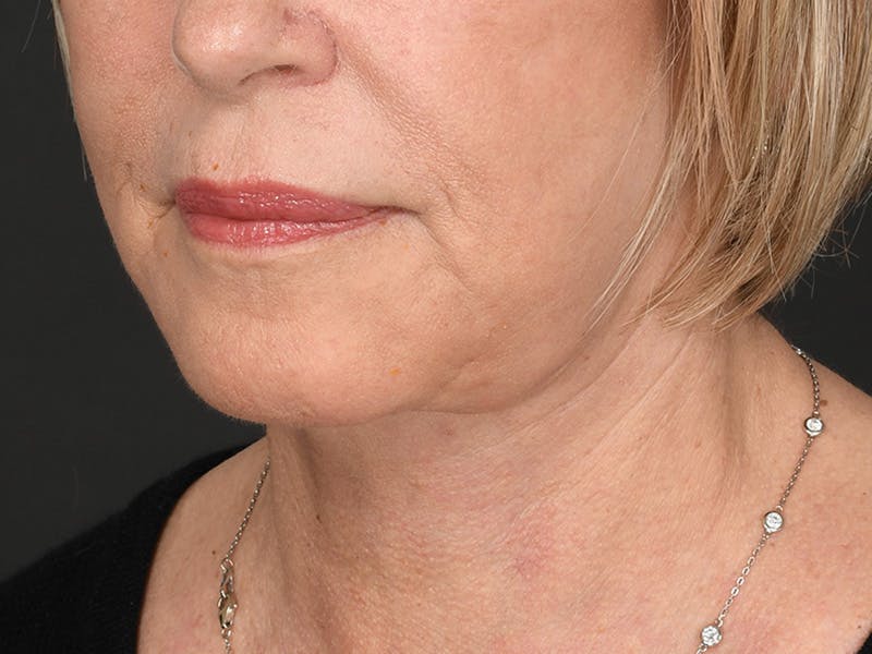 Neck Lift Before & After Gallery - Patient 801111 - Image 10