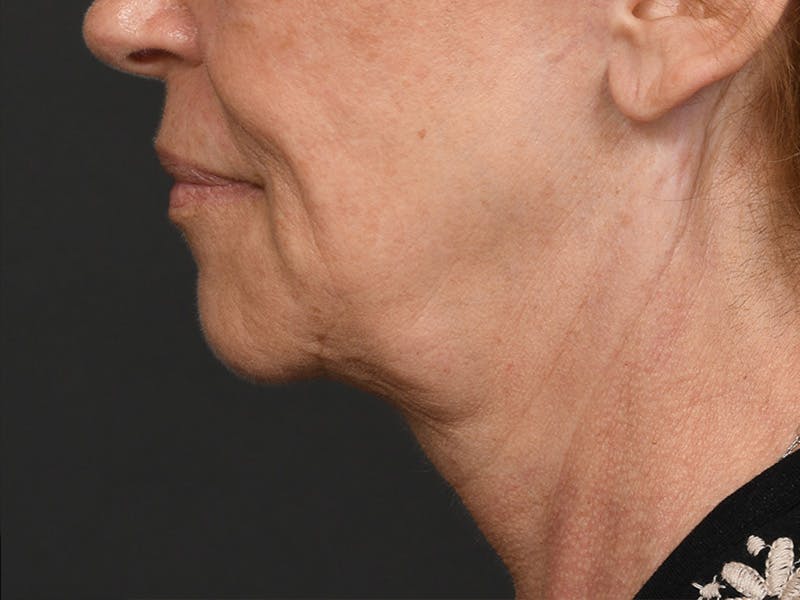 Neck Lift Before & After Gallery - Patient 801111 - Image 11