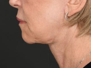 Neck Lift Before & After Gallery - Patient 801111 - Image 12