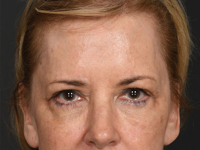 Blepharoplasty Before & After Gallery - Patient 259249 - Image 1