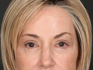 Blepharoplasty Before & After Gallery - Patient 259249 - Image 2