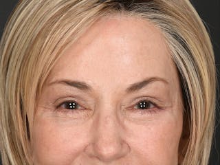 Blepharoplasty Before & After Gallery - Patient 259249 - Image 4