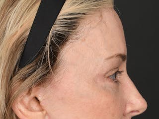Blepharoplasty Before & After Gallery - Patient 259249 - Image 8