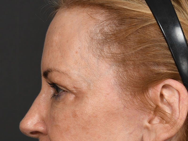 Blepharoplasty Before & After Gallery - Patient 259249 - Image 11