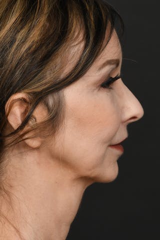 Brow Lift Before & After Gallery - Patient 155407953 - Image 6