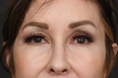 Blepharoplasty Before & After Gallery - Patient 155407959 - Image 2