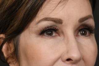 Blepharoplasty Before & After Gallery - Patient 155407959 - Image 4