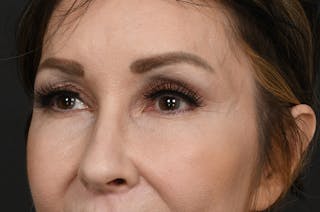 Blepharoplasty Before & After Gallery - Patient 155407959 - Image 8