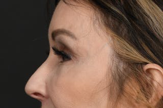 Blepharoplasty Before & After Gallery - Patient 155407959 - Image 10