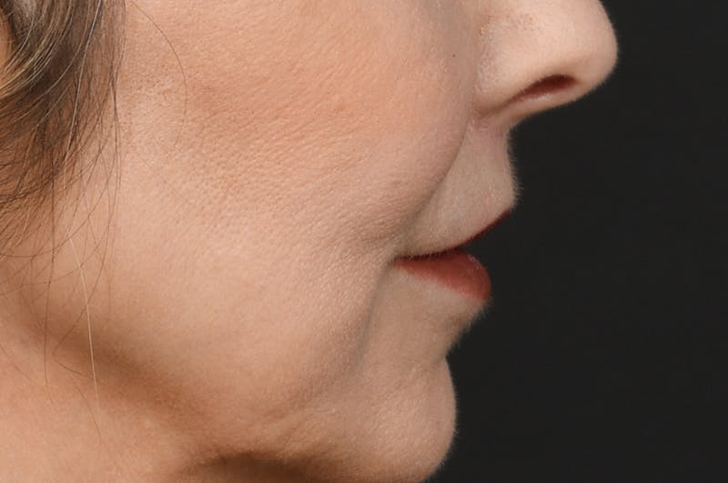 Lip Lift Before & After Gallery - Patient 155407961 - Image 6