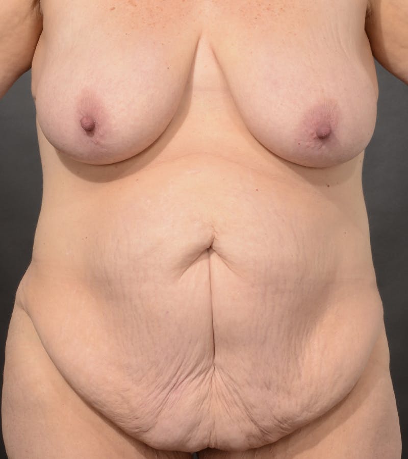 Mommy Makeover Before & After Gallery - Patient 346985 - Image 1