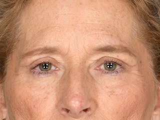 Blepharoplasty Before & After Gallery - Patient 141049 - Image 2