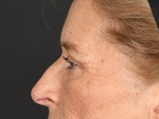 Blepharoplasty Before & After Gallery - Patient 141049 - Image 12