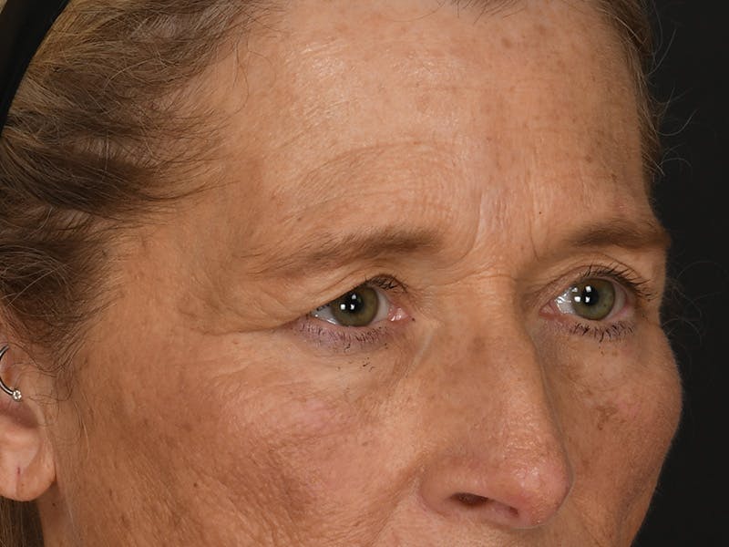 Blepharoplasty Before & After Gallery - Patient 141049 - Image 5