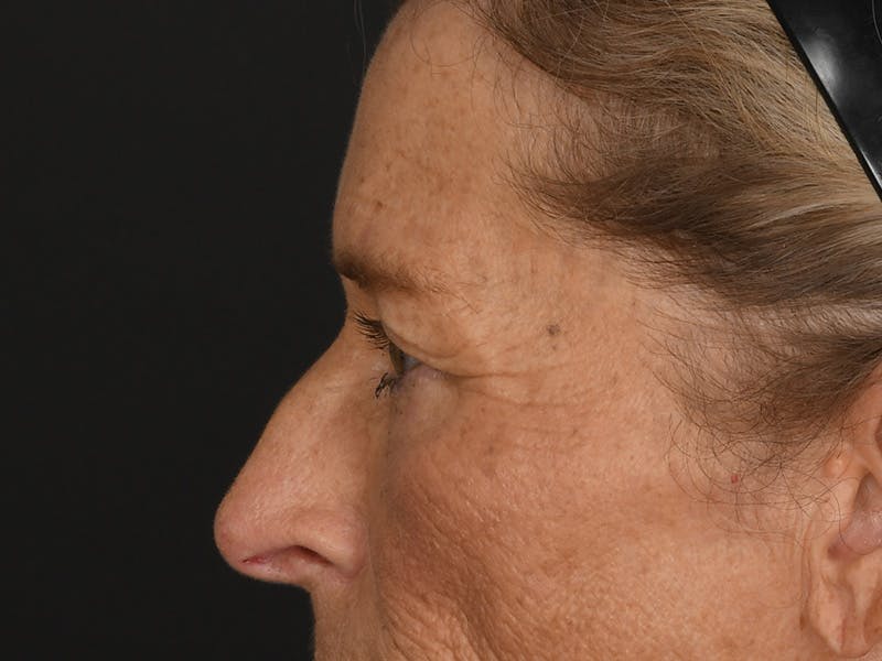 Blepharoplasty Before & After Gallery - Patient 141049 - Image 11