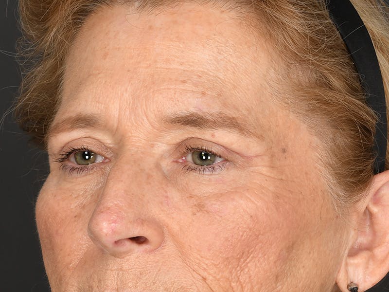 Blepharoplasty Before & After Gallery - Patient 141049 - Image 10