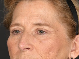 Blepharoplasty Before & After Gallery - Patient 141049 - Image 10
