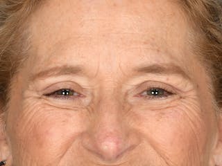 Blepharoplasty Before & After Gallery - Patient 141049 - Image 4